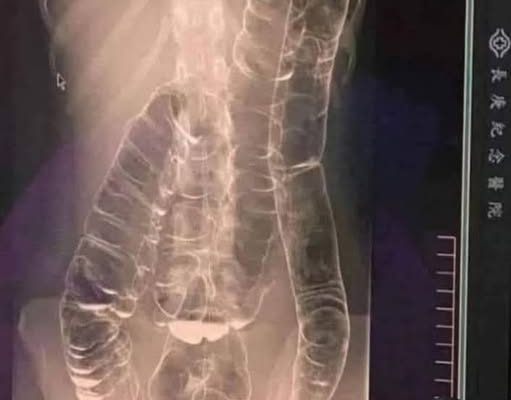 Severe Constipation and Toxic Megacolon: Causes and Solutions