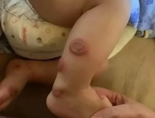 A Skin Condition with Whole-Body Effects: A Case of Sweet Syndrome – DAILY DAILYS